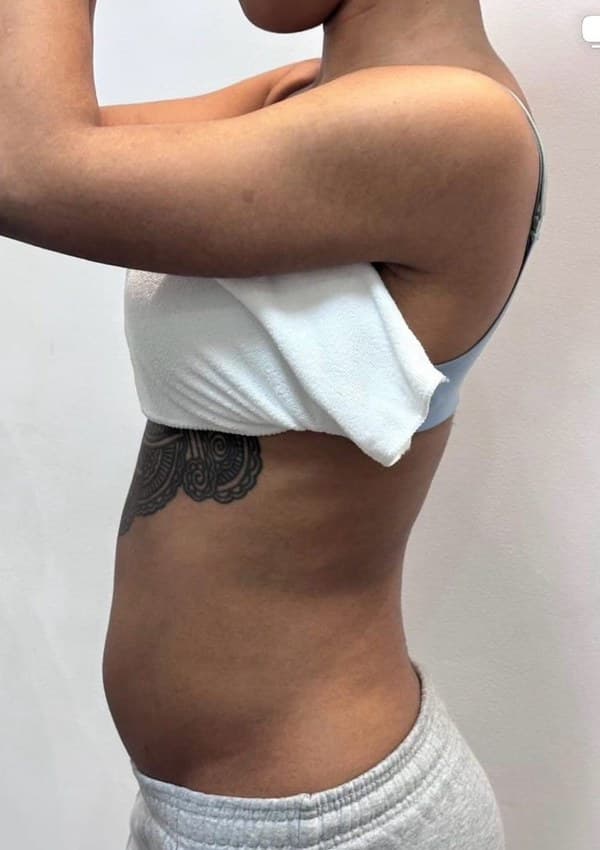 After - Body contouring results