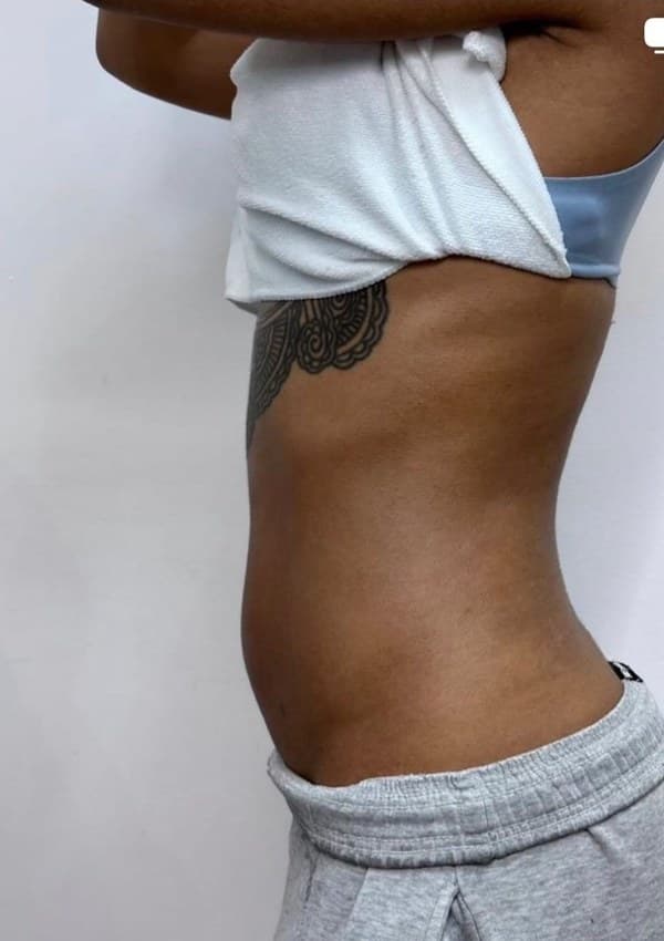 Before - Body contouring results