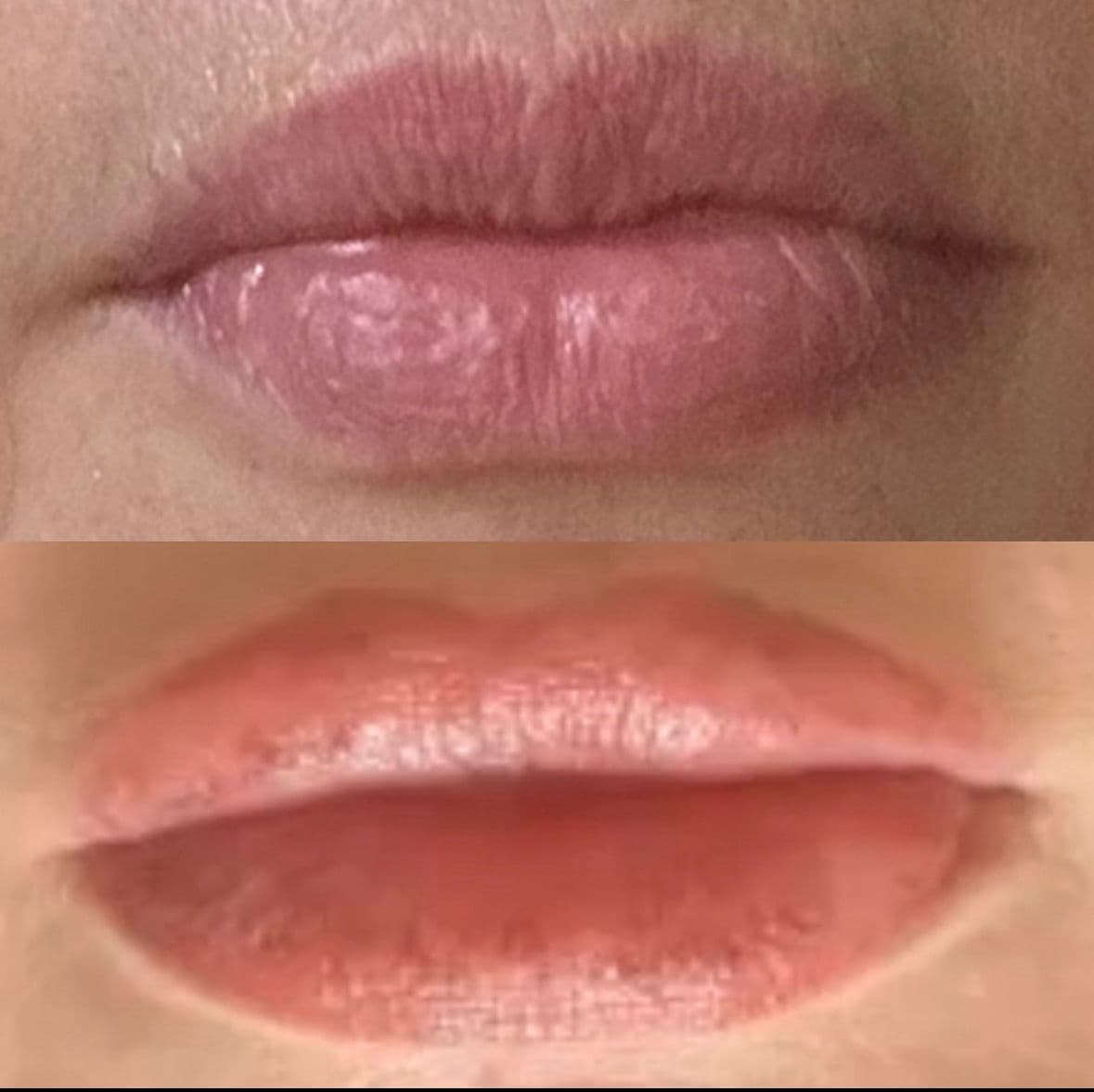 Before - Lip filler results