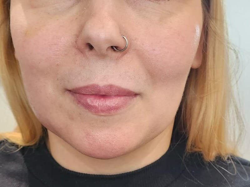 After - Nasolabial fold treatment results