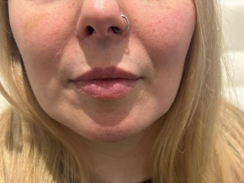 Before - Nasolabial fold treatment results